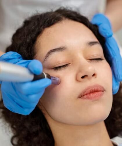 Microneedling